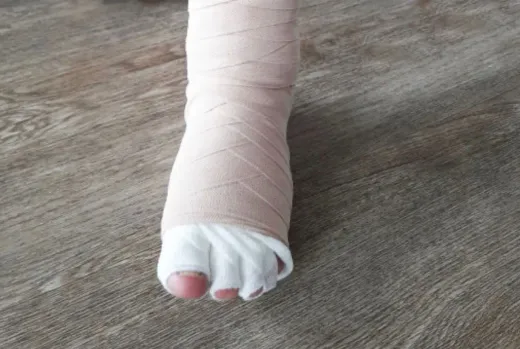 Kompressionsbandagierung – Lymphdrainage Behandlung